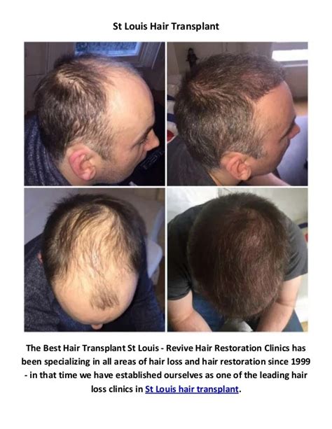 best hair restoration clinic st louis|About St. Louis Hair .